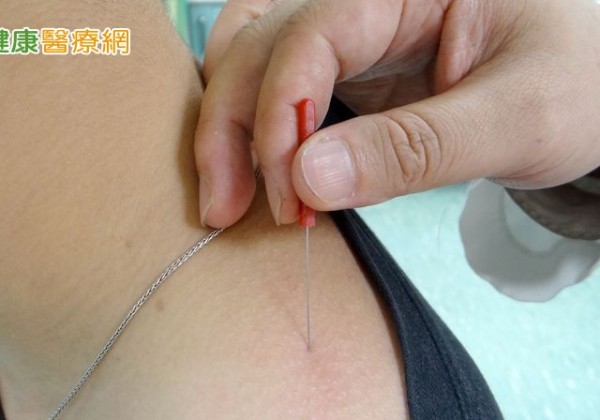 翁肩頸肌肉緊繃導致血壓睡眠雙失控　中醫「小扁針」緩解頑固痠痛
