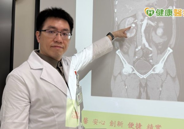 兩年三次腎結石　中年男腎出血後改「1手術」成功碎石