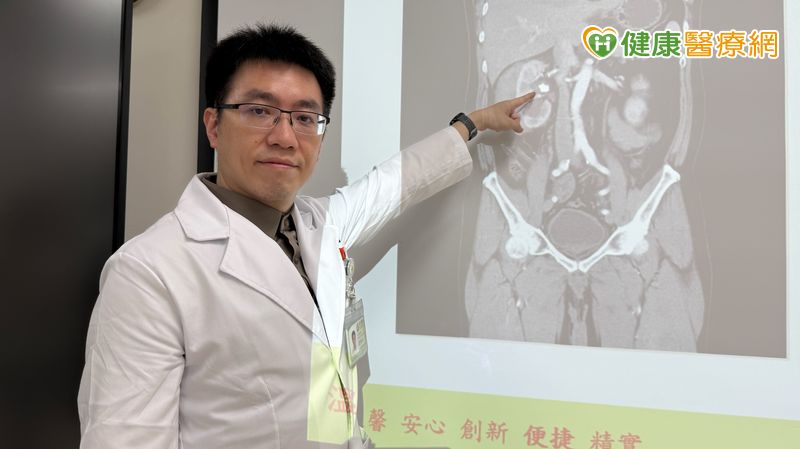 兩年三次腎結石　中年男腎出血後改「1手術」成功碎石
