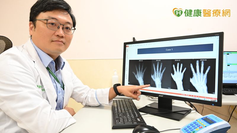 類風濕性關節炎不是不痛就沒事! 醫破解迷思:骨頭恐已悄悄被侵蝕 類風濕性關節炎不是不痛就沒事! 醫破解迷思:骨頭恐已悄悄被侵蝕