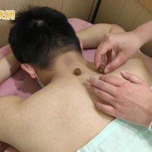 三伏貼改善鼻過敏有解！　中醫師提醒：這3天記得貼滿