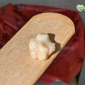 又軟又臭的白色渣渣卻叫扁桃腺「結石」？醫師來解密！4點徵兆自我判斷