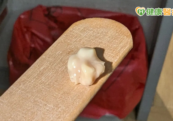 又軟又臭的白色渣渣卻叫扁桃腺「結石」？醫師來解密！4點徵兆自我判斷