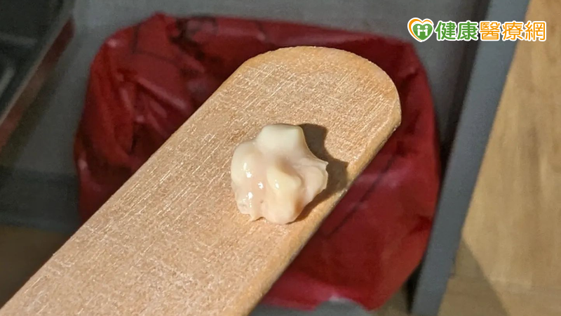 又軟又臭的白色渣渣卻叫扁桃腺「結石」?醫師來解密!4點徵兆自我判斷 又軟又臭的白色渣渣卻叫扁桃腺「結石」?醫師來解密!4點徵兆自我判斷