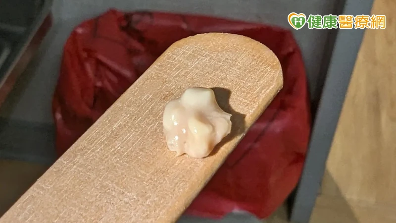 又軟又臭的白色渣渣卻叫扁桃腺「結石」？醫師來解密！4點徵兆自我判斷