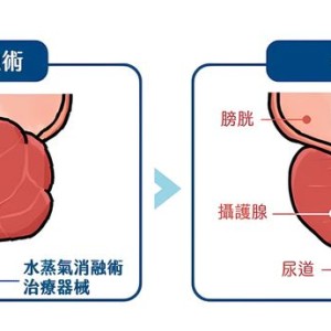 攝護腺肥大治療新選擇　微創手術助擺脫排尿不順之苦