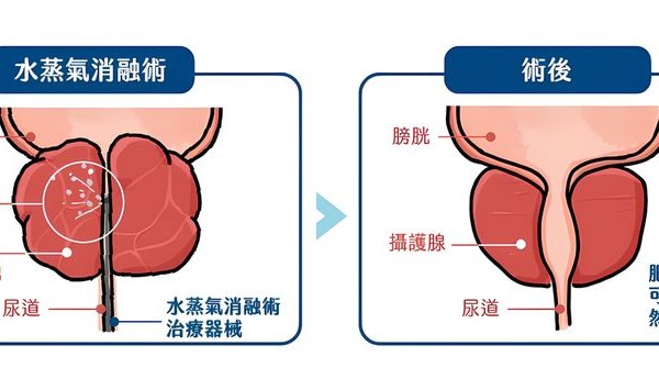 攝護腺肥大治療新選擇　微創手術助擺脫排尿不順之苦