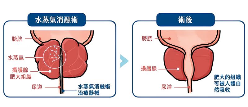 攝護腺肥大治療新選擇 微創手術助擺脫排尿不順之苦 攝護腺肥大治療新選擇 微創手術助擺脫排尿不順之苦