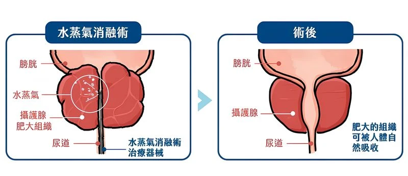 攝護腺肥大治療新選擇　微創手術助擺脫排尿不順之苦