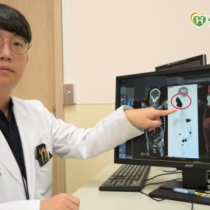 六旬翁頸部腫塊瞬間長成「鴕鳥蛋」　確診罕見伯基特淋巴瘤險奪命