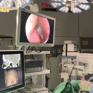 鼻息肉復發鼻塞愈來愈嚴重　「新型治療」助她重拾順暢呼吸
