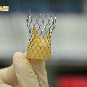 7旬洗腎翁主動脈狹窄復發　植入「瓣中瓣」重獲心生機