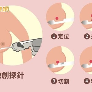 乳房腫瘤4種情況該切除！醫解析「微創手術適應症與優勢」