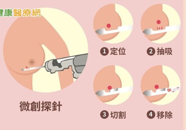 乳房腫瘤4種情況該切除!醫解析「微創手術適應症與優勢」 乳房腫瘤4種情況該切除!醫解析「微創手術適應症與優勢」