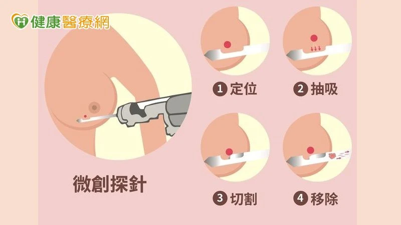 乳房腫瘤4種情況該切除！醫解析「微創手術適應症與優勢」