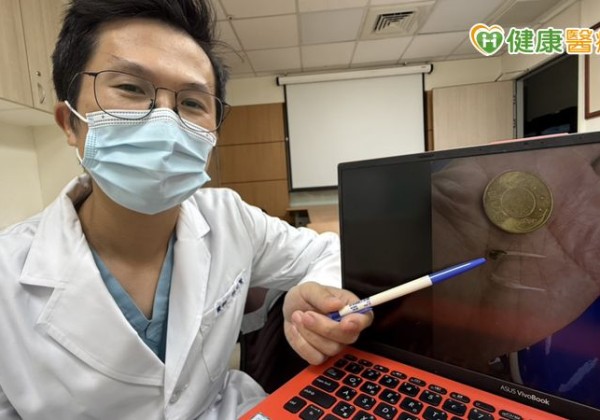 胸痛半天誤當心肌梗塞　竟是魚刺卡在食道裡
