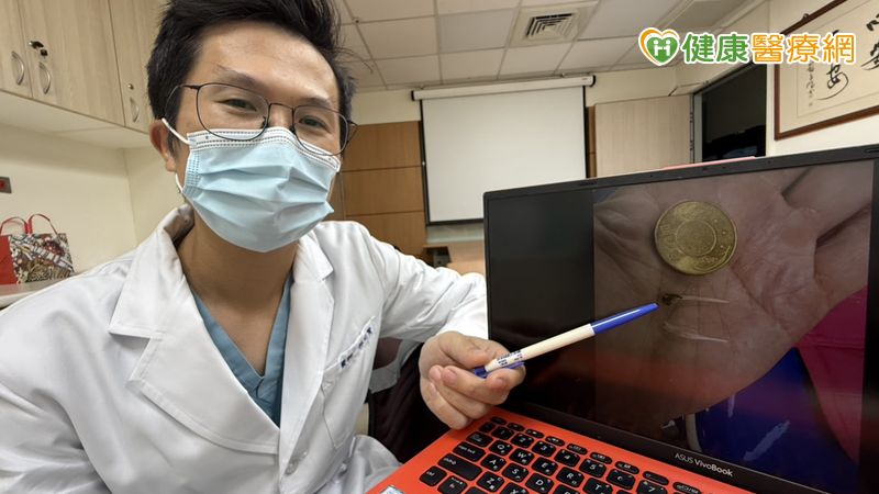 胸痛半天誤當心肌梗塞 竟是魚刺卡在食道裡 胸痛半天誤當心肌梗塞 竟是魚刺卡在食道裡