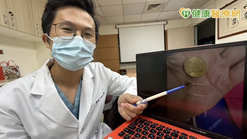 胸痛半天誤當心肌梗塞　竟是魚刺卡在食道裡