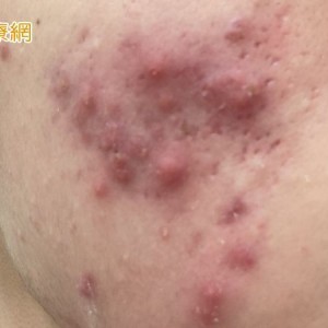 高三生壓力大狂嗑炸雞、手搖「吃出滿臉痘」 ！醫教甩爛臉秘訣