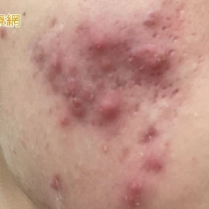 高三生壓力大狂嗑炸雞、手搖「吃出滿臉痘」 ！醫教甩爛臉秘訣