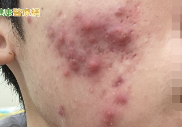 高三生壓力大狂嗑炸雞、手搖「吃出滿臉痘」 ！醫教甩爛臉秘訣