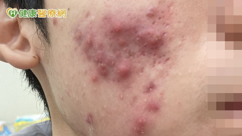 高三生壓力大狂嗑炸雞、手搖「吃出滿臉痘」 ！醫教甩爛臉秘訣