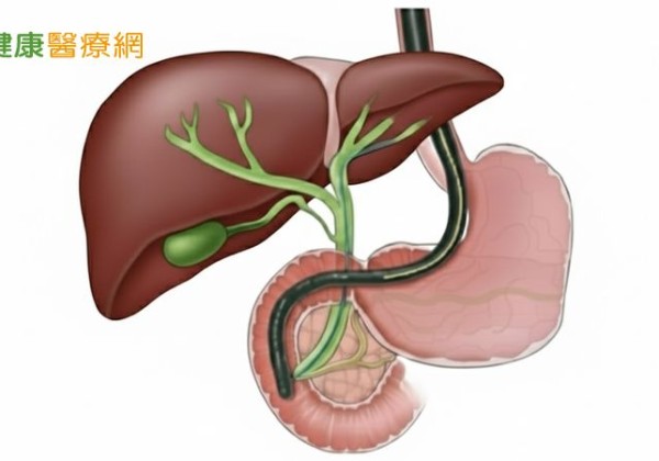膽結石、膽管結石傻傻分不清　醫解析「症狀與治療」差異
