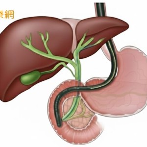 膽結石、膽管結石傻傻分不清　醫解析「症狀與治療」差異