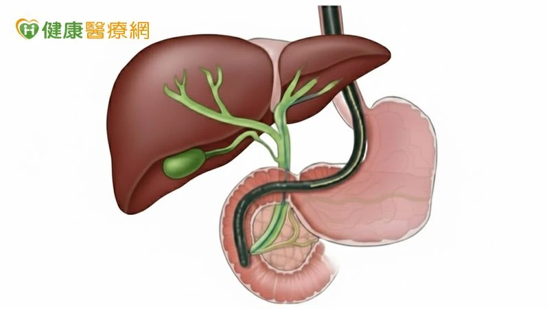 膽結石、膽管結石傻傻分不清　醫解析「症狀與治療」差異