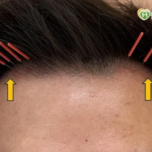 35 歲男髮際線後退「M型禿」！中醫「1治療」改善掉髮、新髮冒出