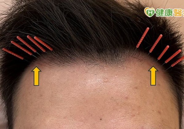 35 歲男髮際線後退「M型禿」！中醫「1治療」改善掉髮、新髮冒出