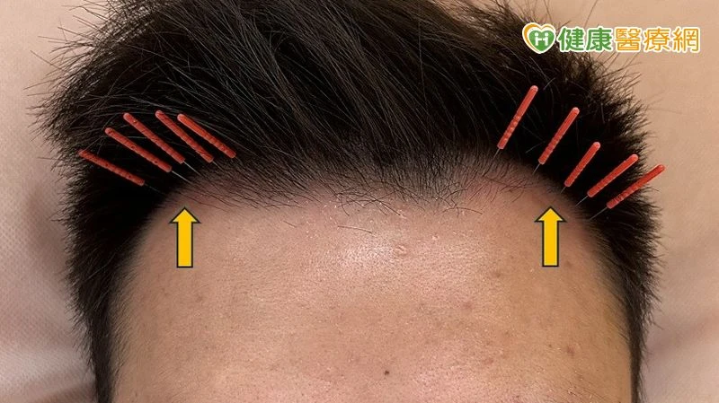 35 歲男髮際線後退「M型禿」！中醫「1治療」改善掉髮、新髮冒出